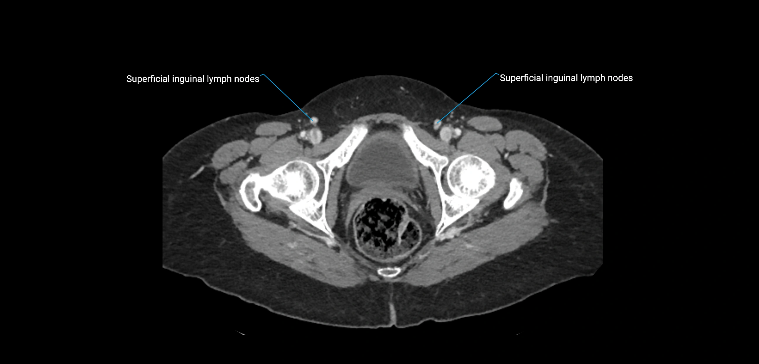 CT ct abdominal lymph nodes  axial cross sectional anatomy  enchanced radiology image -img-00002-00402.webp